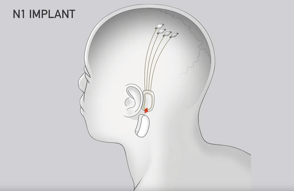 Neuralink N1 implantaat Neuralink N1 implantaat